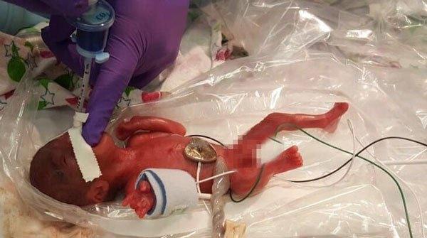 世界最小245グラムで生まれた赤ちゃんが無事退院　米カリフォルニア