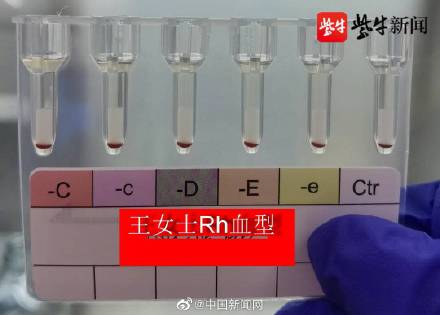 【音声ニュース】江蘇省で非常に珍しい「黄金の血」を持つ女性2人を確認