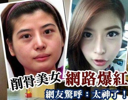 台湾26歳女性が骨を削る整形手術の全貌を公開